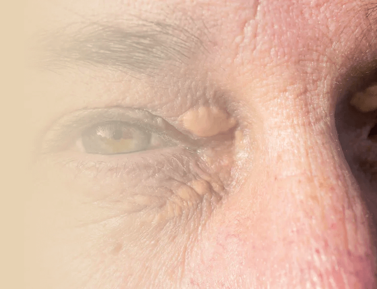 Behandling af kolesterolaflejringer